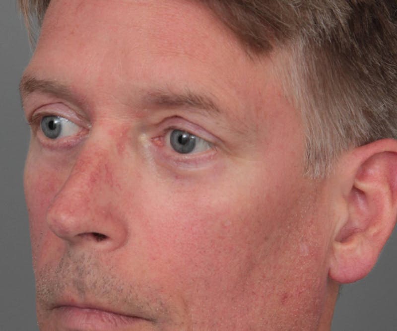 Eyelid Lift Before & After Gallery - Patient 480111 - Image 4 - Scott Chapin, MD