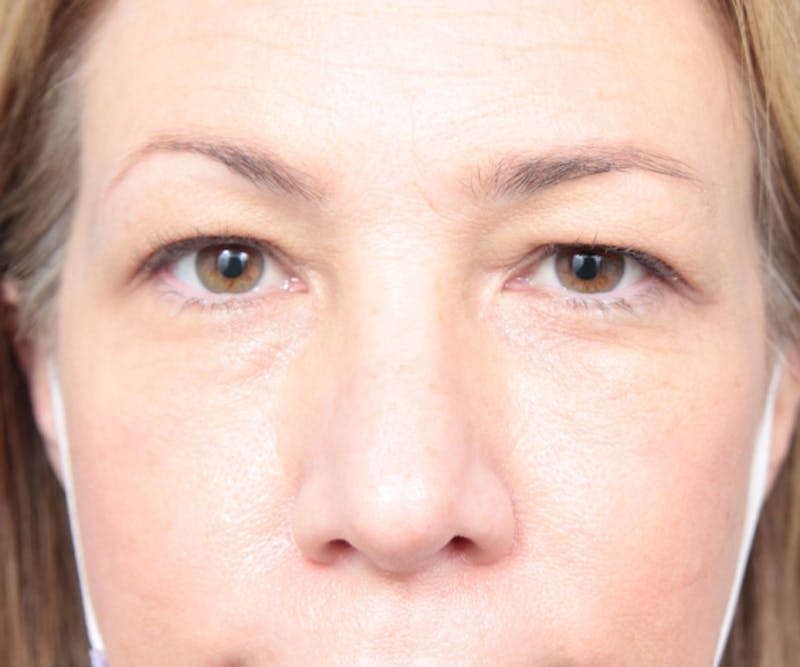 Eyelid Lift Before & After Gallery - Patient 349616 - Image 1 - Scott Chapin, MD