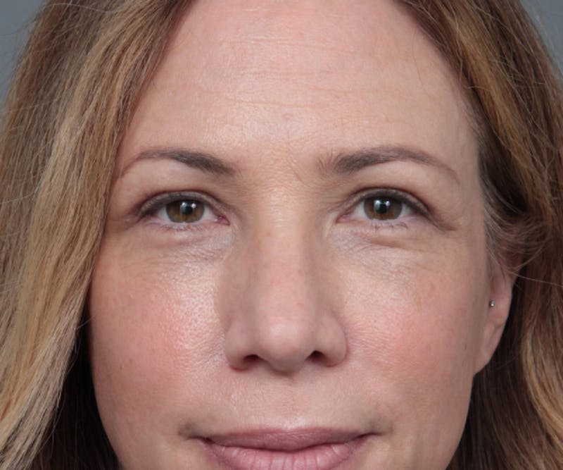 Eyelid Lift Before & After Gallery - Patient 349616 - Image 2 - Scott Chapin, MD
