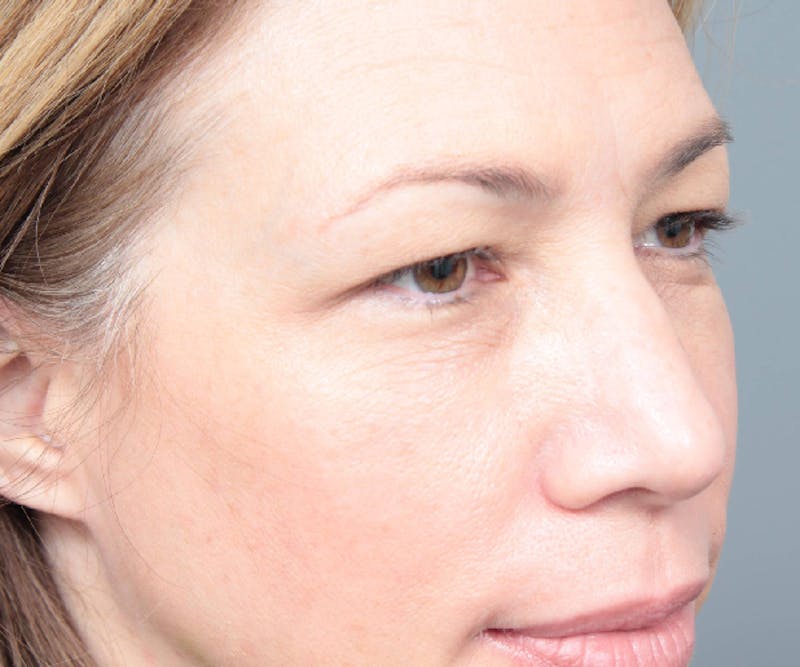 Eyelid Lift Before & After Gallery - Patient 349616 - Image 3 - Scott Chapin, MD