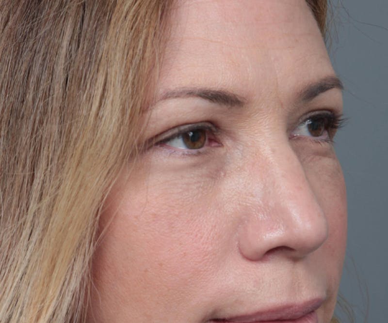 Eyelid Lift Before & After Gallery - Patient 349616 - Image 4 - Scott Chapin, MD