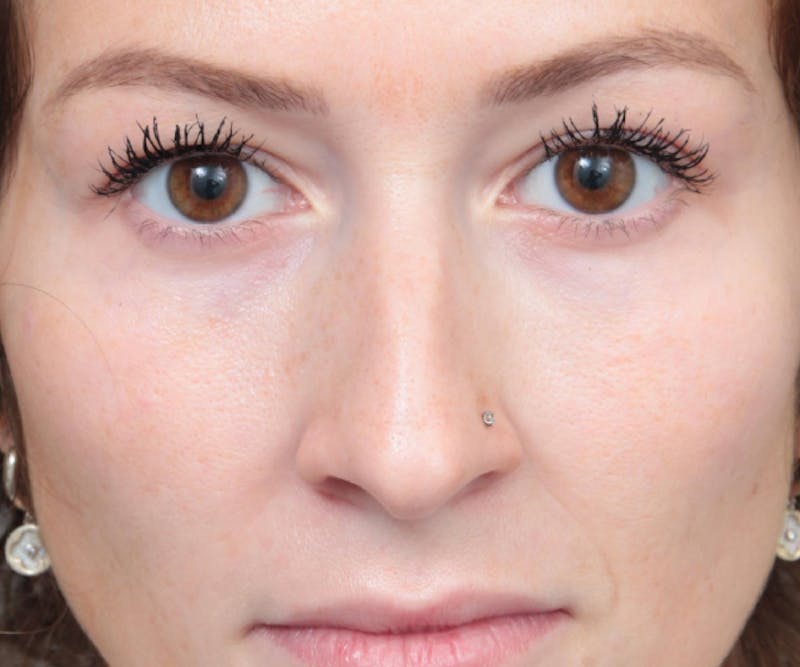 Eyelid Lift Before & After Gallery - Patient 392194 - Image 1 - Scott Chapin, MD