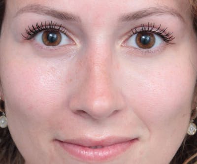 Eyelid Lift Before & After Gallery - Patient 392194 - Image 2 - Scott Chapin, MD