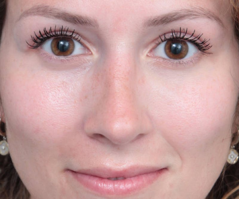 Eyelid Lift Before & After Gallery - Patient 392194 - Image 2 - Scott Chapin, MD