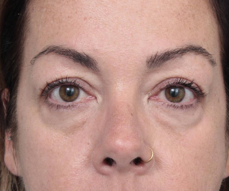 Eyelid Lift Before & After Gallery - Patient 272661 - Image 1 - Scott Chapin, MD