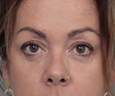 Eyelid Lift Before & After Gallery - Patient 272661 - Image 2 - Scott Chapin, MD