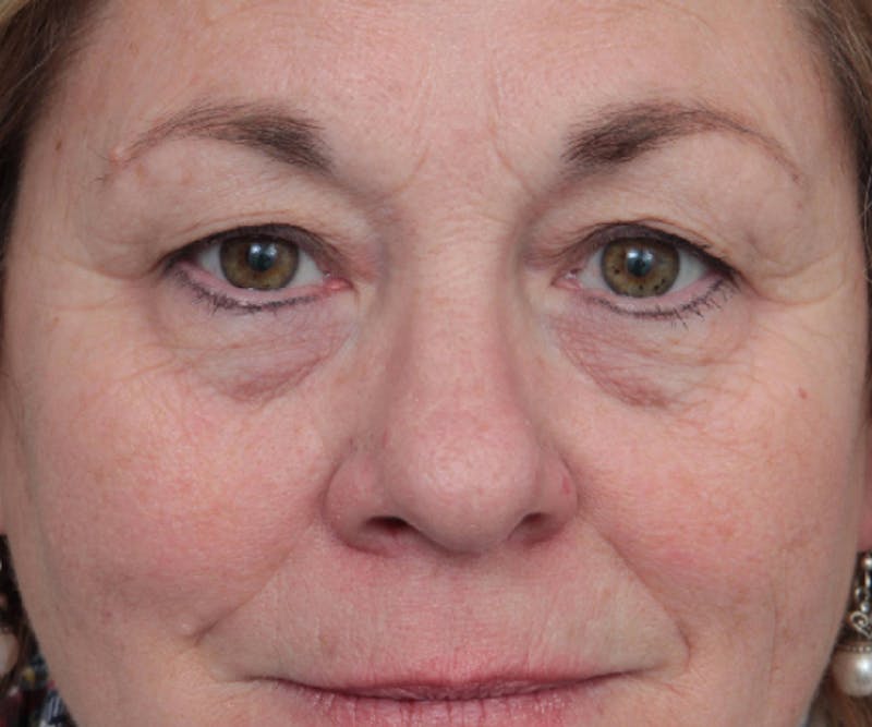 Eyelid Lift Before & After Gallery - Patient 152701 - Image 1 - Scott Chapin, MD
