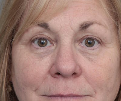 Eyelid Lift Before & After Gallery - Patient 152701 - Image 2 - Scott Chapin, MD