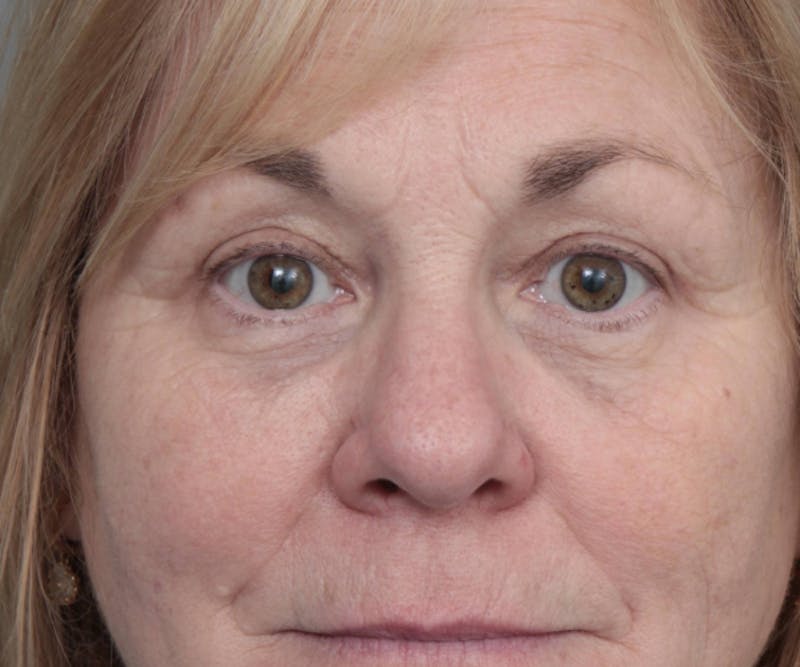 Eyelid Lift Before & After Gallery - Patient 152701 - Image 2 - Scott Chapin, MD
