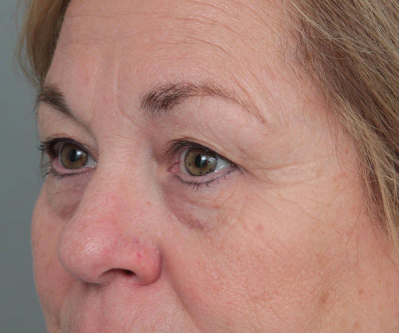 Eyelid Lift Before & After Gallery - Patient 152701 - Image 3 - Scott Chapin, MD