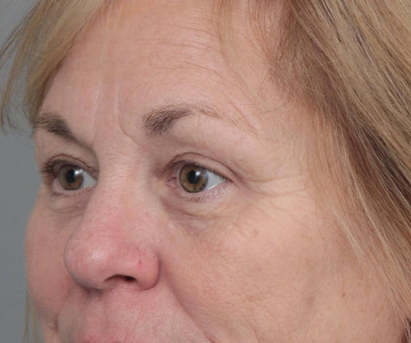 Eyelid Lift Before & After Gallery - Patient 152701 - Image 4 - Scott Chapin, MD