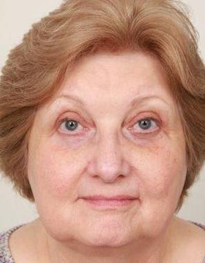 Eyelid Lift Before & After Gallery - Patient 996211 - Image 2 - Scott Chapin, MD