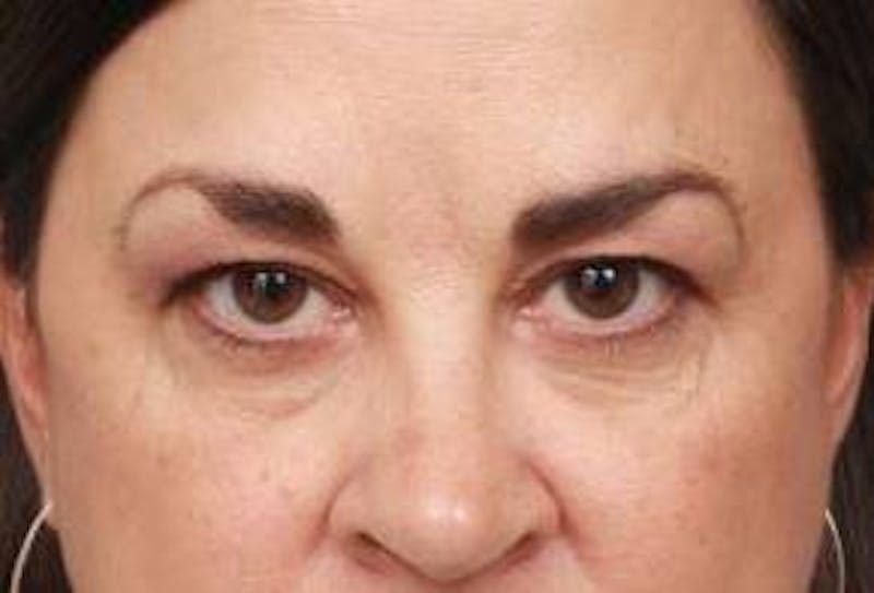 Eyelid Lift Before & After Gallery - Patient 180891 - Image 1 - Scott Chapin, MD