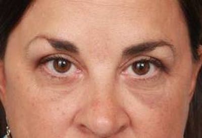 Eyelid Lift Before & After Gallery - Patient 180891 - Image 2 - Scott Chapin, MD