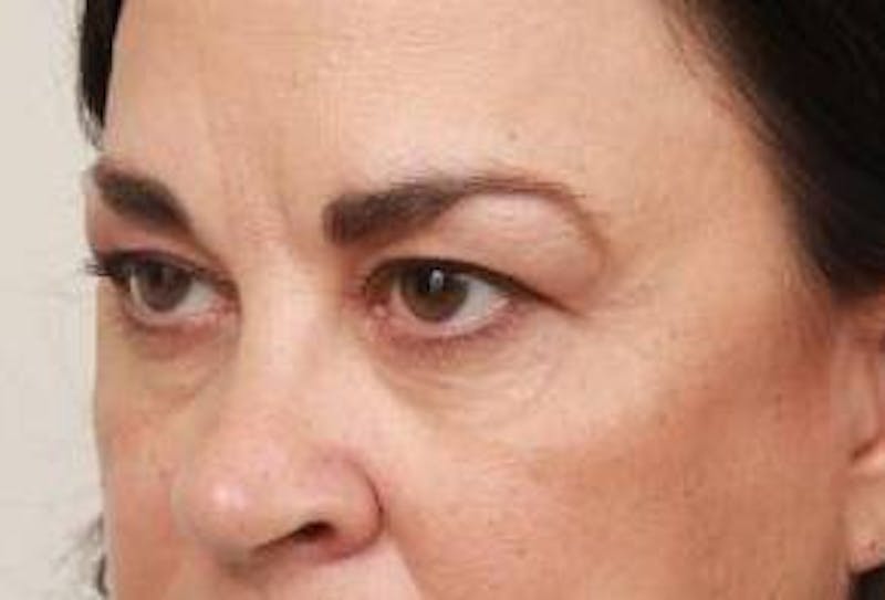 Eyelid Lift Before & After Gallery - Patient 180891 - Image 3 - Scott Chapin, MD