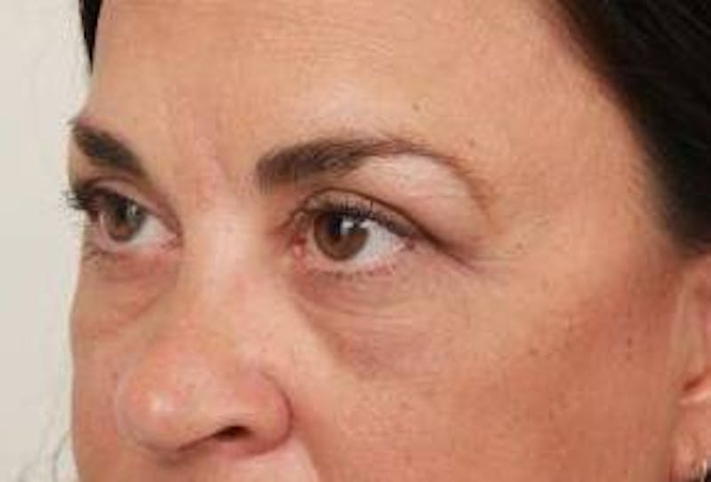 Eyelid Lift Before & After Gallery - Patient 180891 - Image 4 - Scott Chapin, MD