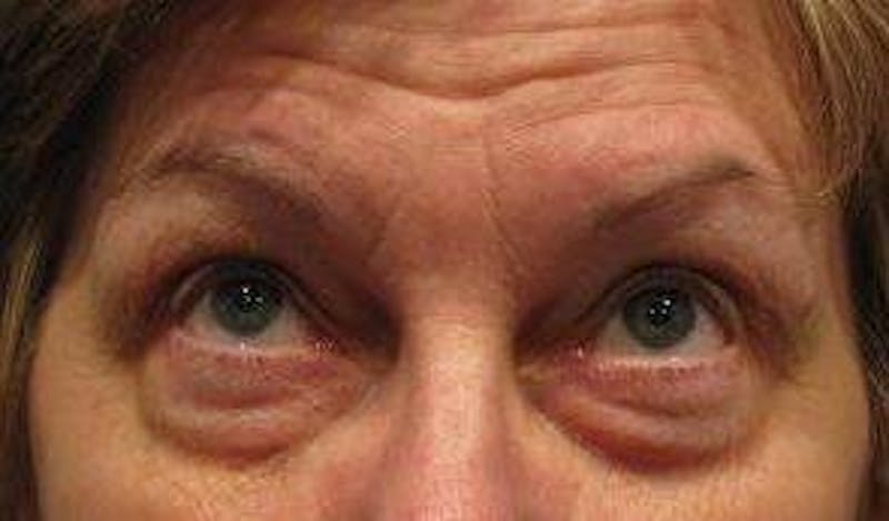 Eyelid Lift Before & After Gallery - Patient 178002 - Image 1 - Scott Chapin, MD