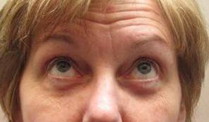 Eyelid Lift Before & After Gallery - Patient 178002 - Image 2 - Scott Chapin, MD