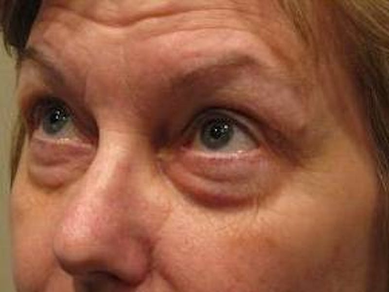 Eyelid Lift Before & After Gallery - Patient 178002 - Image 3 - Scott Chapin, MD