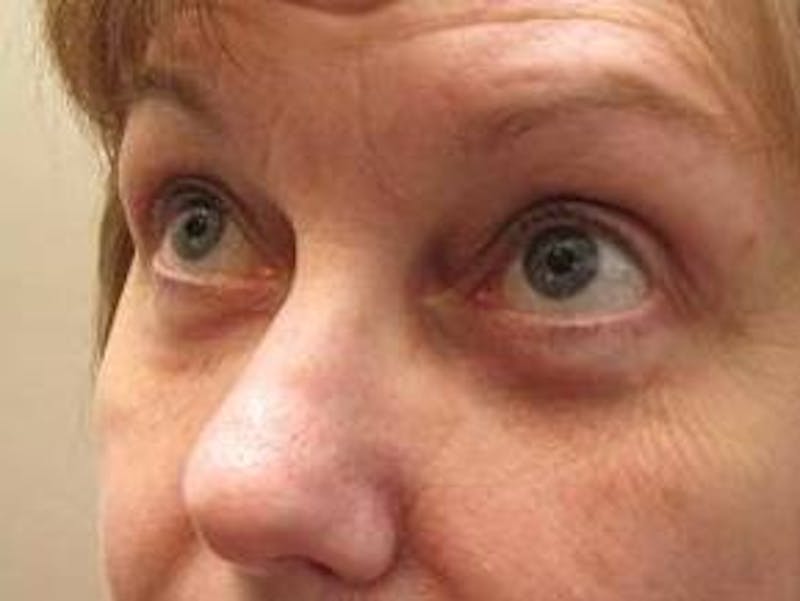 Eyelid Lift Before & After Gallery - Patient 178002 - Image 4 - Scott Chapin, MD