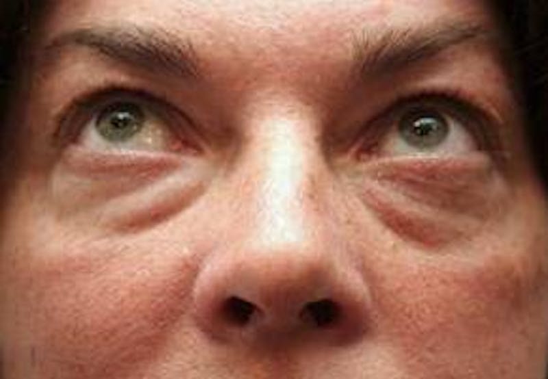 Eyelid Lift Before & After Gallery - Patient 329530 - Image 1 - Scott Chapin, MD