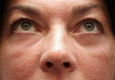 Eyelid Lift Before & After Gallery - Patient 329530 - Image 2 - Scott Chapin, MD
