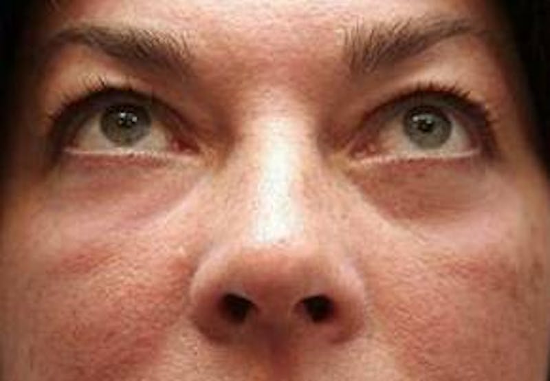 Eyelid Lift Before & After Gallery - Patient 329530 - Image 2 - Scott Chapin, MD