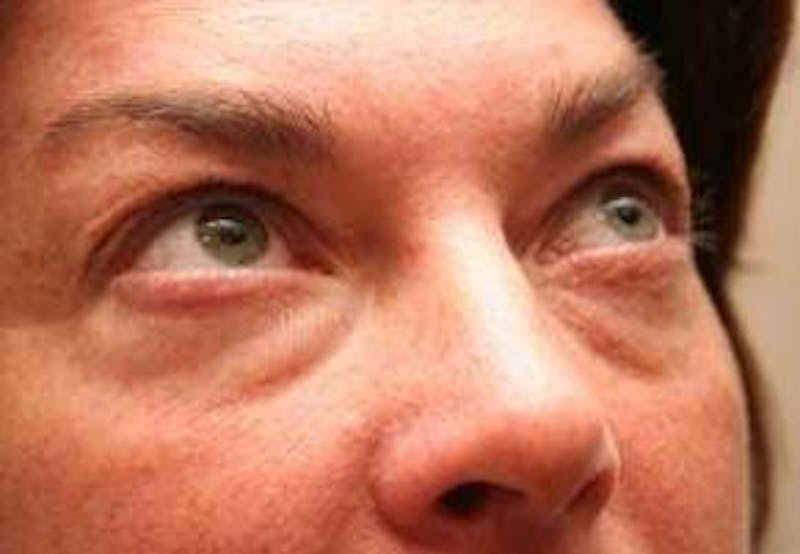 Eyelid Lift Before & After Gallery - Patient 329530 - Image 3 - Scott Chapin, MD
