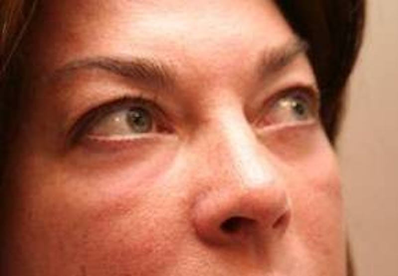 Eyelid Lift Before & After Gallery - Patient 329530 - Image 4 - Scott Chapin, MD