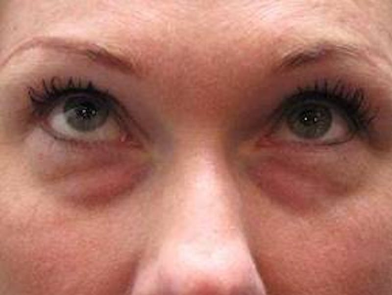 Eyelid Lift Before & After Gallery - Patient 421554 - Image 1 - Scott Chapin, MD