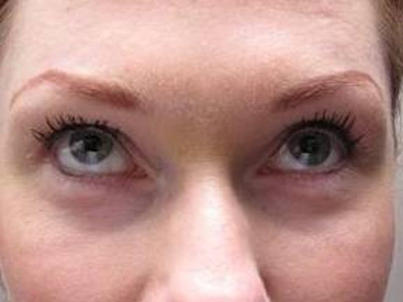 Eyelid Lift Before & After Gallery - Patient 421554 - Image 2 - Scott Chapin, MD