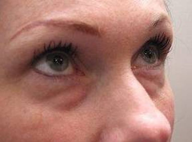Eyelid Lift Before & After Gallery - Patient 421554 - Image 3 - Scott Chapin, MD