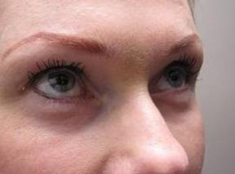 Eyelid Lift Before & After Gallery - Patient 421554 - Image 4 - Scott Chapin, MD