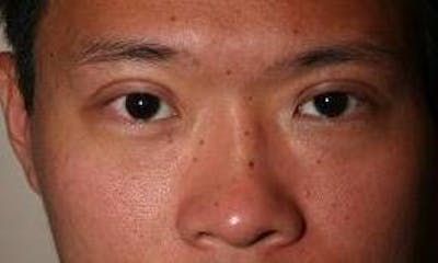 Eyelid Lift Before & After Gallery - Patient 389782 - Image 2 - Scott Chapin, MD