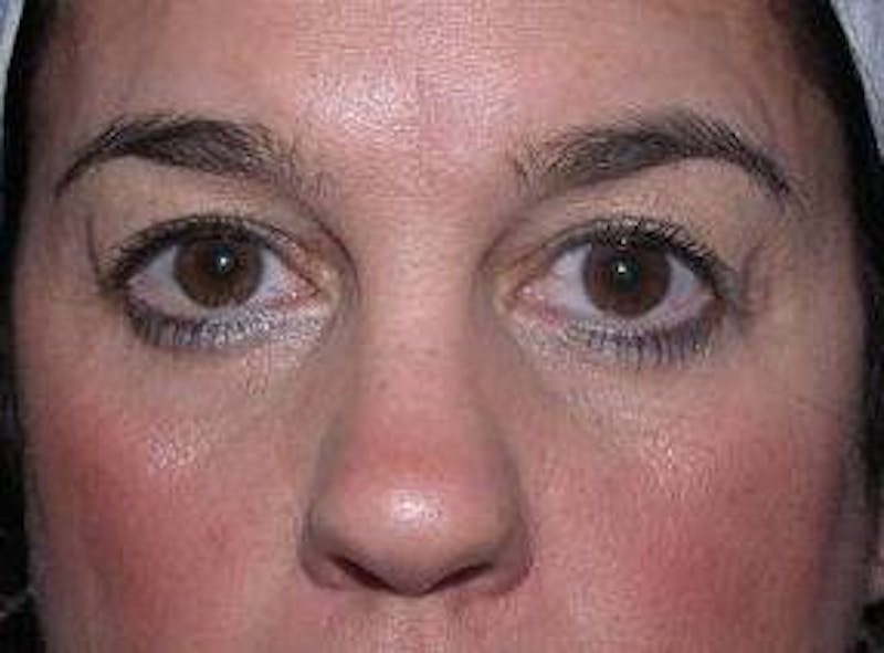 Eyelid Lift Before & After Gallery - Patient 259516 - Image 1 - Scott Chapin, MD