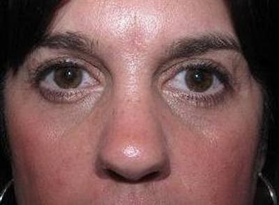 Eyelid Lift Before & After Gallery - Patient 259516 - Image 2 - Scott Chapin, MD