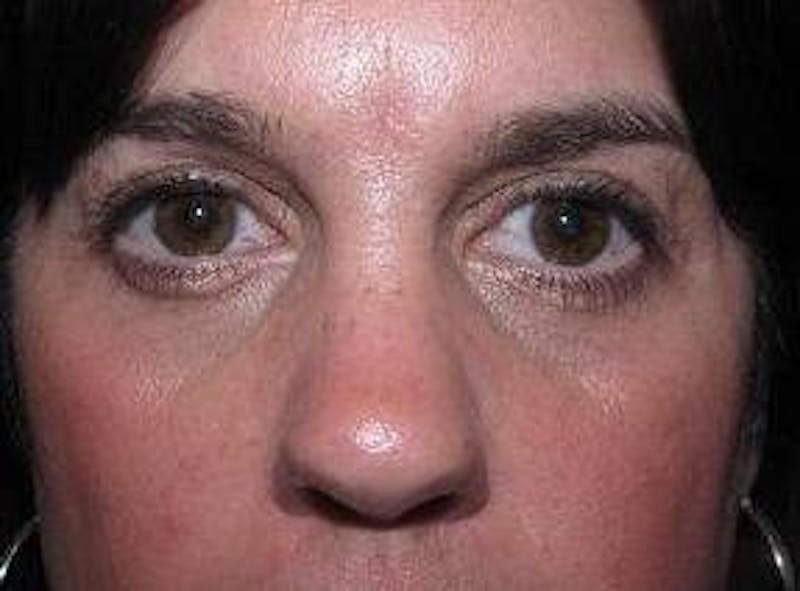 Eyelid Lift Before & After Gallery - Patient 259516 - Image 2 - Scott Chapin, MD