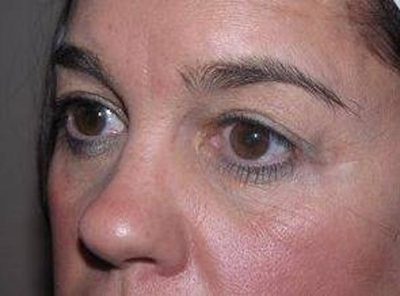 Eyelid Lift Before & After Gallery - Patient 259516 - Image 3 - Scott Chapin, MD