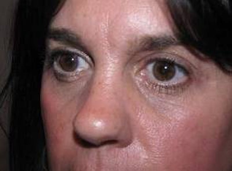 Eyelid Lift Before & After Gallery - Patient 259516 - Image 4 - Scott Chapin, MD