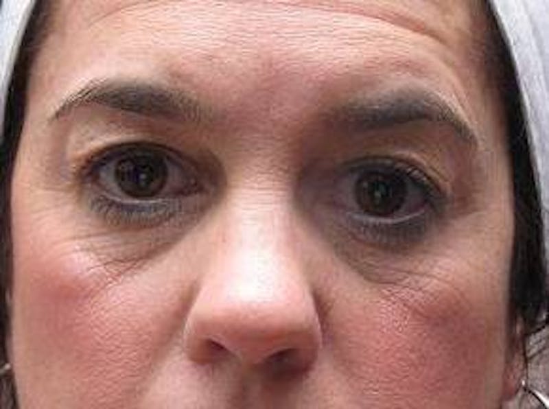 Eyelid Lift Before & After Gallery - Patient 259516 - Image 5 - Scott Chapin, MD