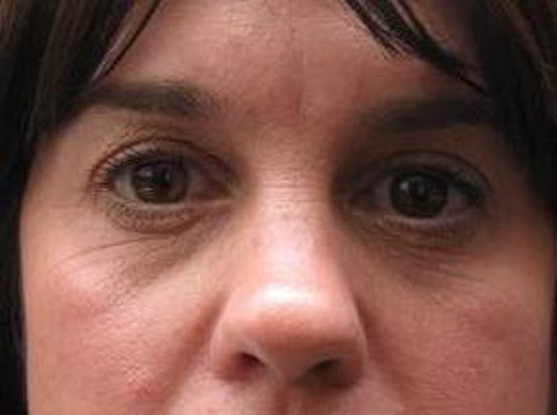 Eyelid Lift Before & After Gallery - Patient 259516 - Image 6 - Scott Chapin, MD