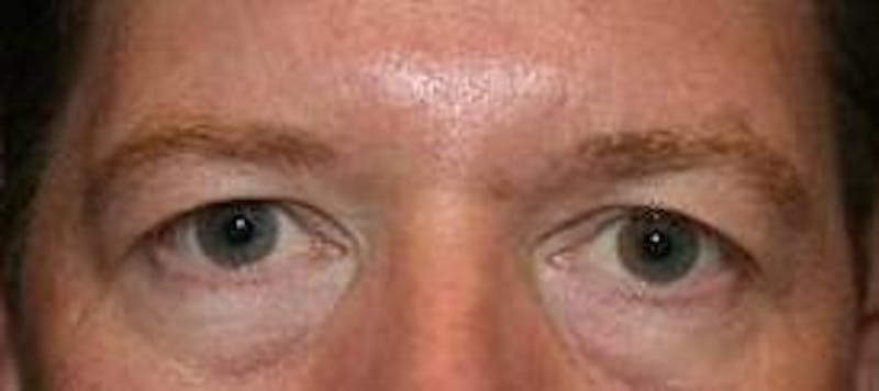 Eyelid Lift Before & After Gallery - Patient 163590 - Image 1 - Scott Chapin, MD