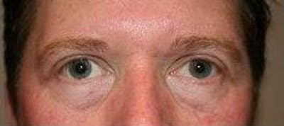 Eyelid Lift Before & After Gallery - Patient 163590 - Image 2 - Scott Chapin, MD