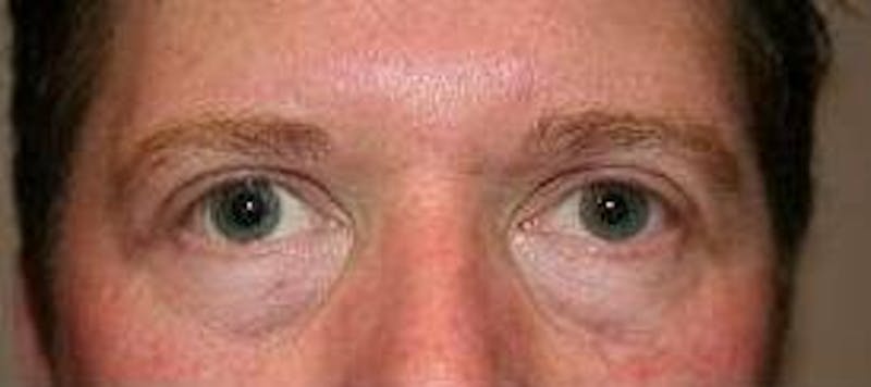 Eyelid Lift Before & After Gallery - Patient 163590 - Image 2 - Scott Chapin, MD