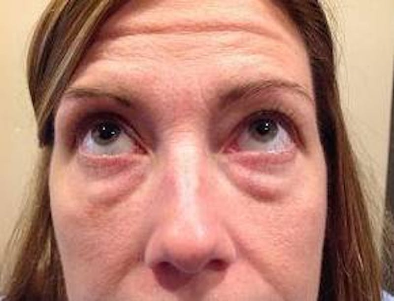 Eyelid Lift Before & After Gallery - Patient 126003 - Image 1 - Scott Chapin, MD