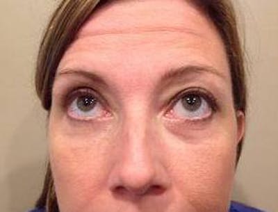 Eyelid Lift Before & After Gallery - Patient 126003 - Image 2 - Scott Chapin, MD