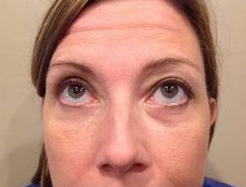Eyelid Lift Before & After Gallery - Patient 126003 - Image 2 - Scott Chapin, MD