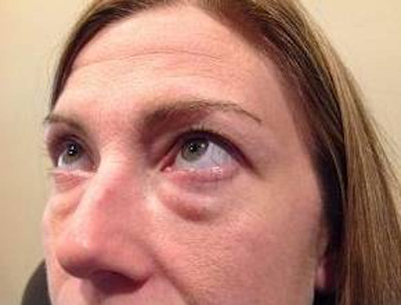 Eyelid Lift Before & After Gallery - Patient 126003 - Image 3 - Scott Chapin, MD