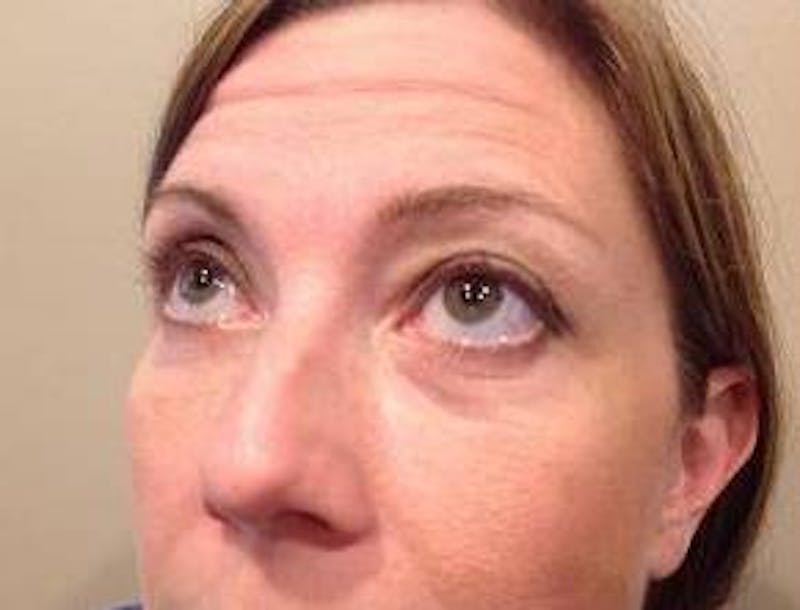 Eyelid Lift Before & After Gallery - Patient 126003 - Image 4 - Scott Chapin, MD