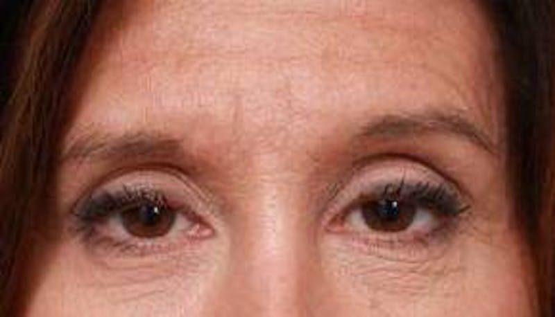 Eyelid Lift Before & After Gallery - Patient 149233 - Image 1 - Scott Chapin, MD